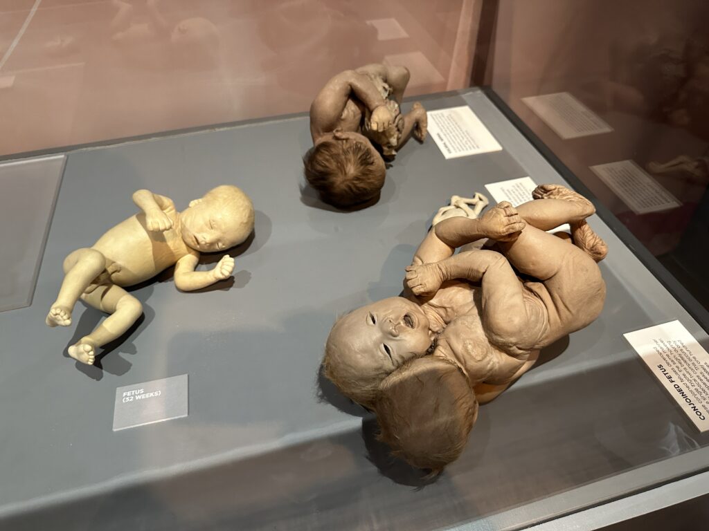 Advanced fetus specimans under glass. One of which is conjoined twins. 